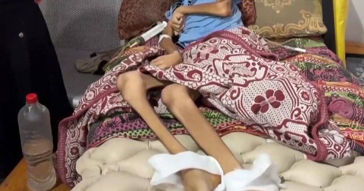 Disturbing images of starvation in Gaza